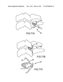 FACET JOINT IMPLANTS AND DELIVERY TOOLS diagram and image