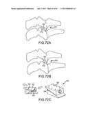 FACET JOINT IMPLANTS AND DELIVERY TOOLS diagram and image