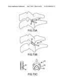 FACET JOINT IMPLANTS AND DELIVERY TOOLS diagram and image