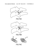 FACET JOINT IMPLANTS AND DELIVERY TOOLS diagram and image