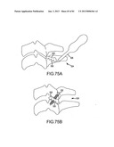 FACET JOINT IMPLANTS AND DELIVERY TOOLS diagram and image