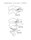 FACET JOINT IMPLANTS AND DELIVERY TOOLS diagram and image