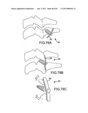 FACET JOINT IMPLANTS AND DELIVERY TOOLS diagram and image