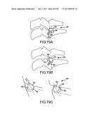 FACET JOINT IMPLANTS AND DELIVERY TOOLS diagram and image