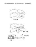 FACET JOINT IMPLANTS AND DELIVERY TOOLS diagram and image