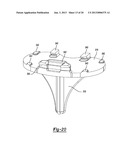 KNEE PROSTHESIS diagram and image