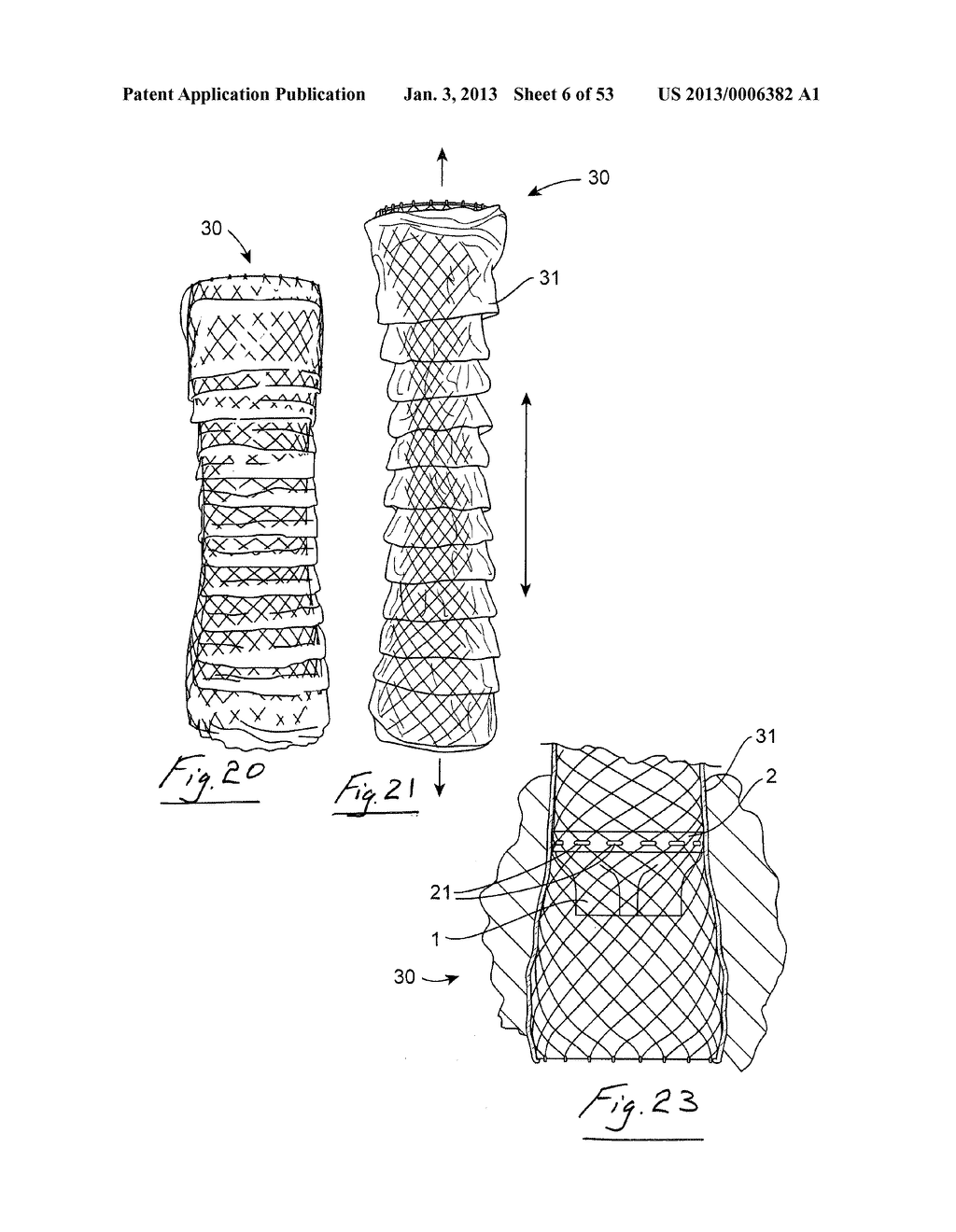 GASTROINTESTINAL IMPLANT DEVICE - diagram, schematic, and image 07