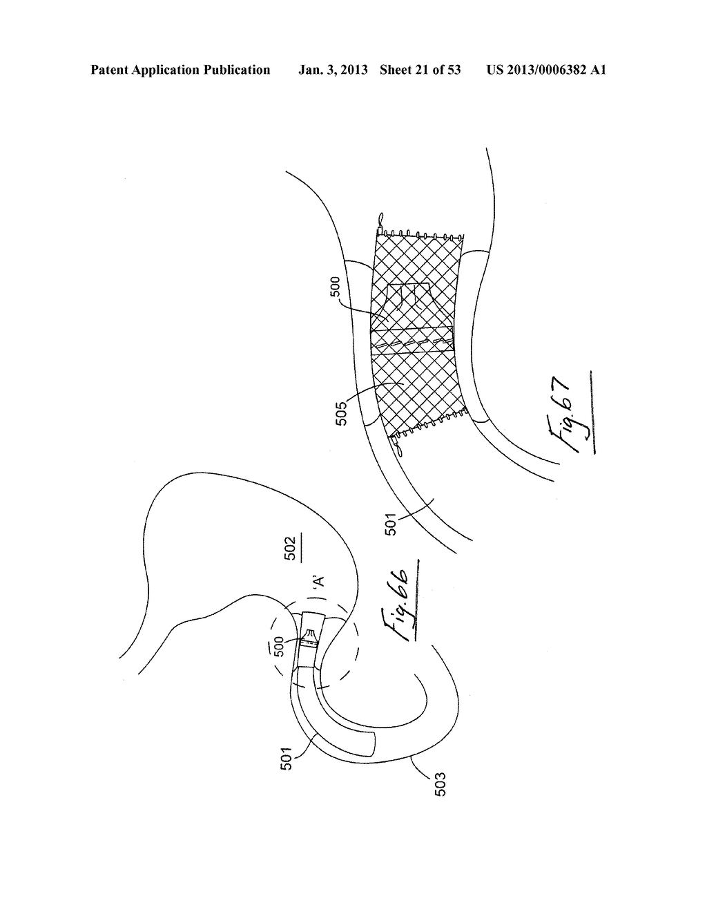 GASTROINTESTINAL IMPLANT DEVICE - diagram, schematic, and image 22