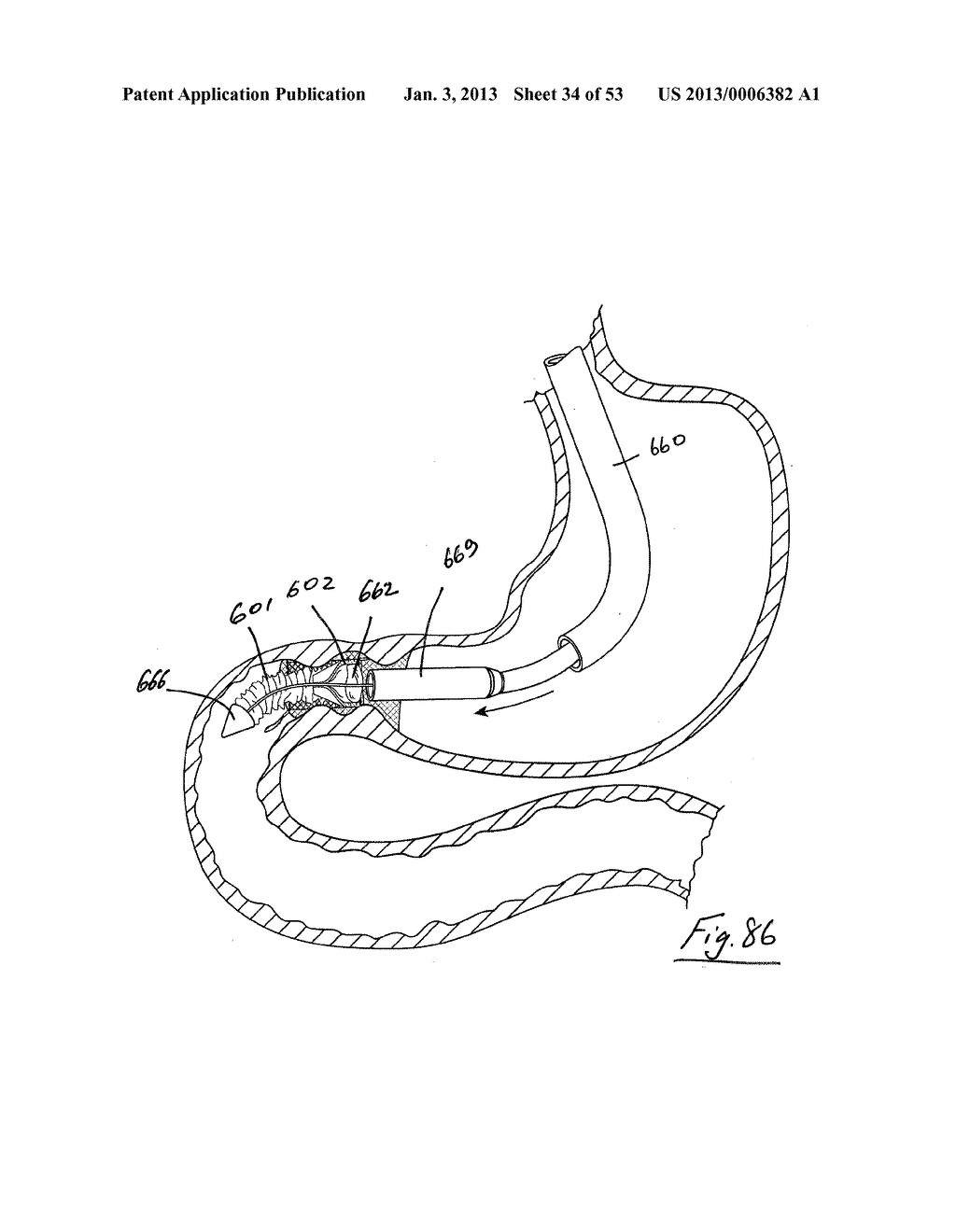 GASTROINTESTINAL IMPLANT DEVICE - diagram, schematic, and image 35