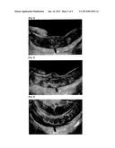 BURR FOR ALVEOLAR BONE diagram and image