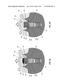 DENTAL RETENTION SYSTEMS diagram and image