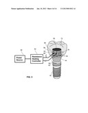 DENTAL RETENTION SYSTEMS diagram and image