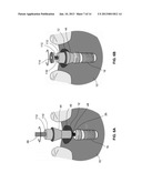 DENTAL RETENTION SYSTEMS diagram and image