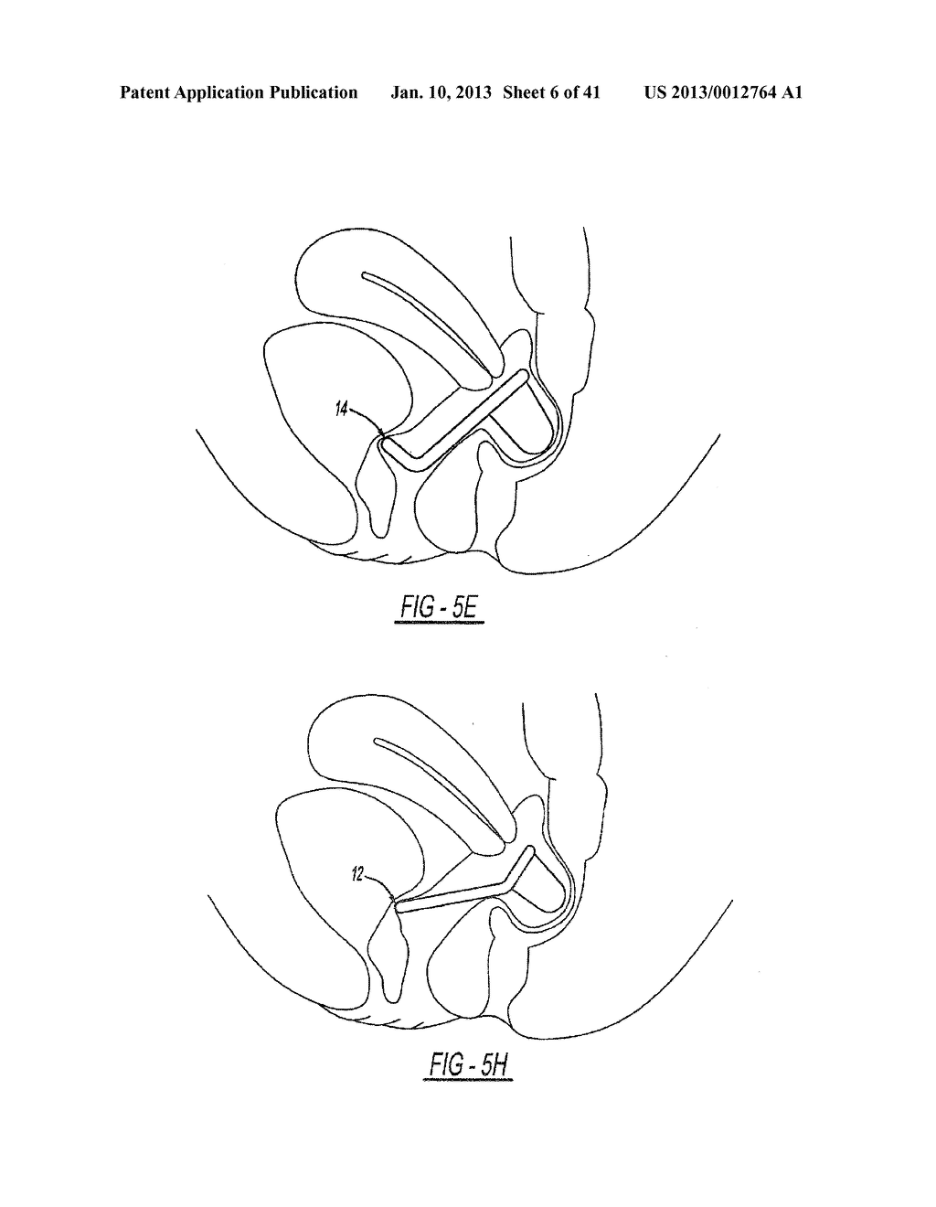 INTRA-VAGINAL DEVICE FOR FECAL INCONTINENCE - diagram, schematic, and image 07