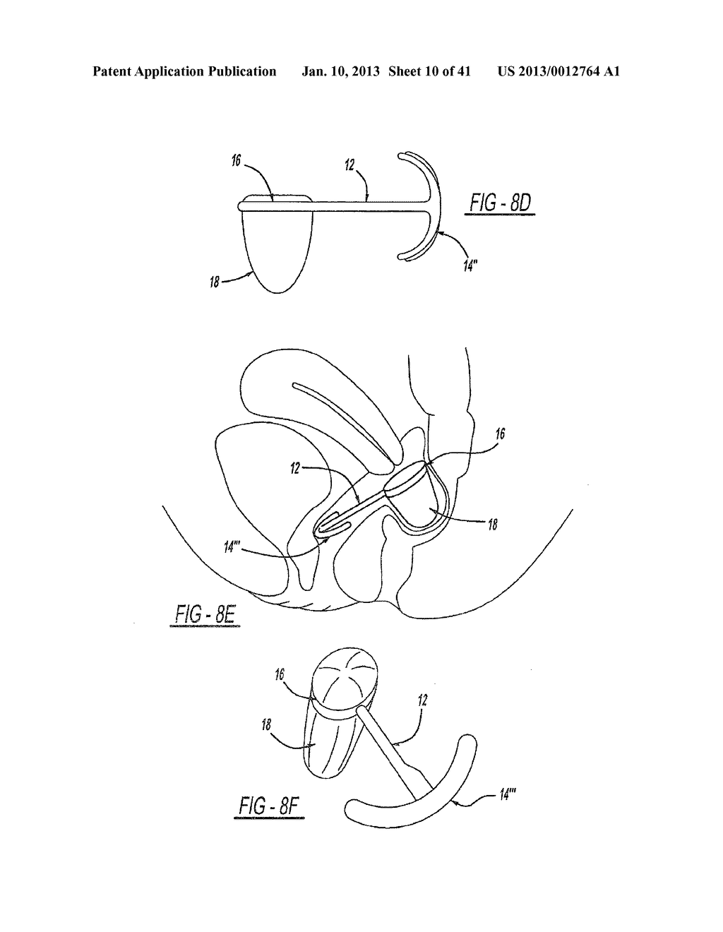 INTRA-VAGINAL DEVICE FOR FECAL INCONTINENCE - diagram, schematic, and image 11