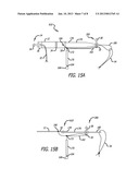 Adjustable Implant diagram and image