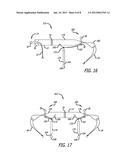 Adjustable Implant diagram and image