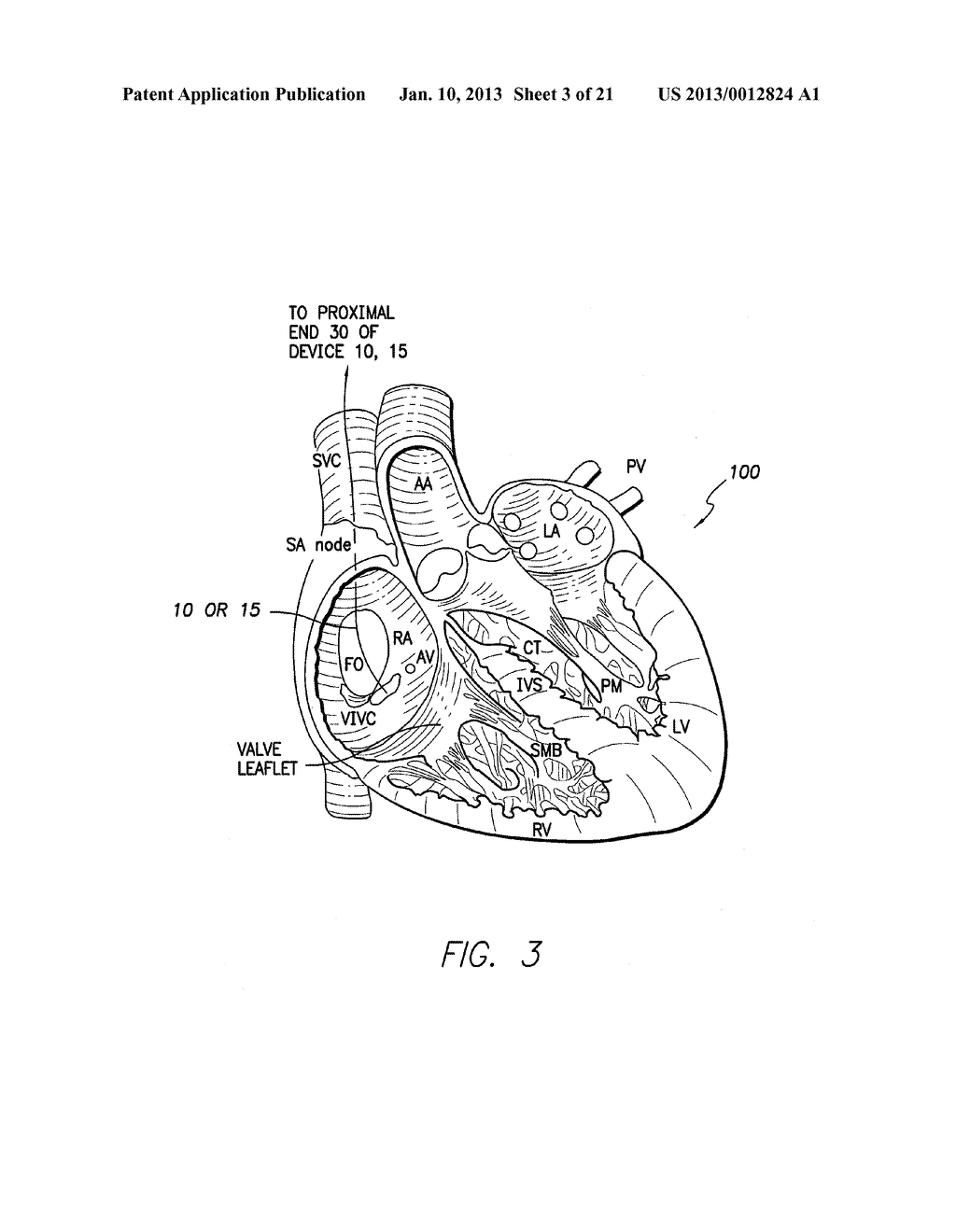 CORONARY VENOUS SYSTEM PRESSURE SENSING - diagram, schematic, and image 04