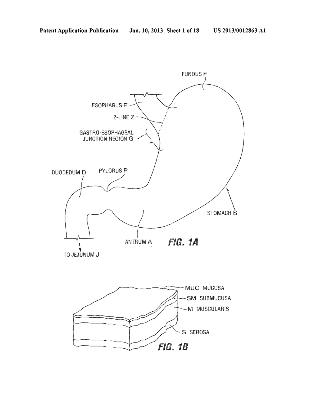 RESTRICTIVE AND/OR OBSTRUCTIVE IMPLANT SYSTEM FOR INDUCING WEIGHT LOSS - diagram, schematic, and image 02