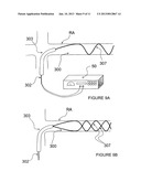 METHODS AND APPARATUS FOR PERFORMING A NON-CONTINUOUS CIRCUMFERENTIAL     TREATMENT OF A BODY LUMEN diagram and image