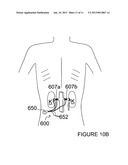 METHODS AND APPARATUS FOR PERFORMING A NON-CONTINUOUS CIRCUMFERENTIAL     TREATMENT OF A BODY LUMEN diagram and image