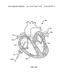 DEFLECTABLE SHEATH CATHETERS diagram and image