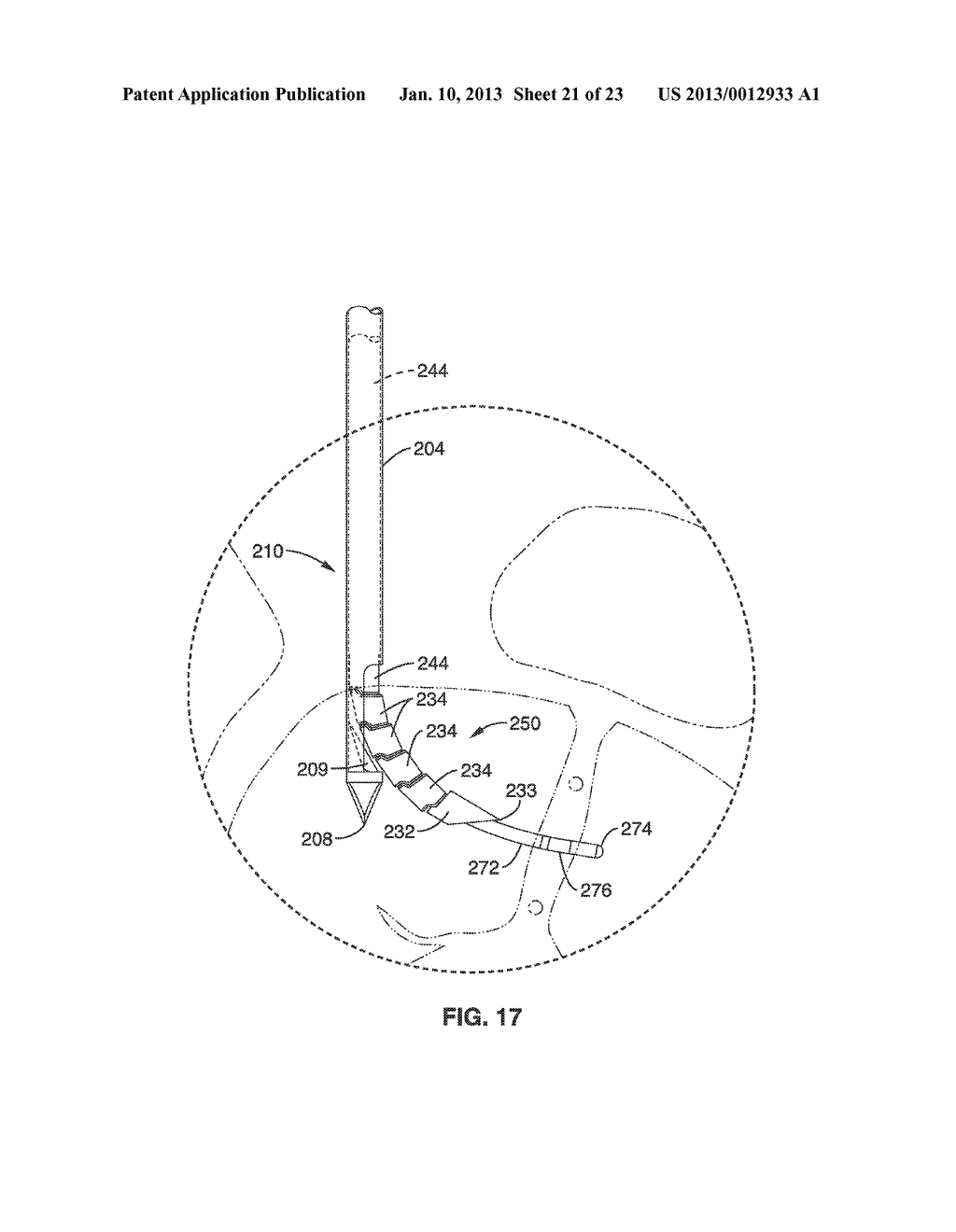 SYSTEMS FOR DENERVATION OF BASIVERTEBRAL NERVES - diagram, schematic, and image 22