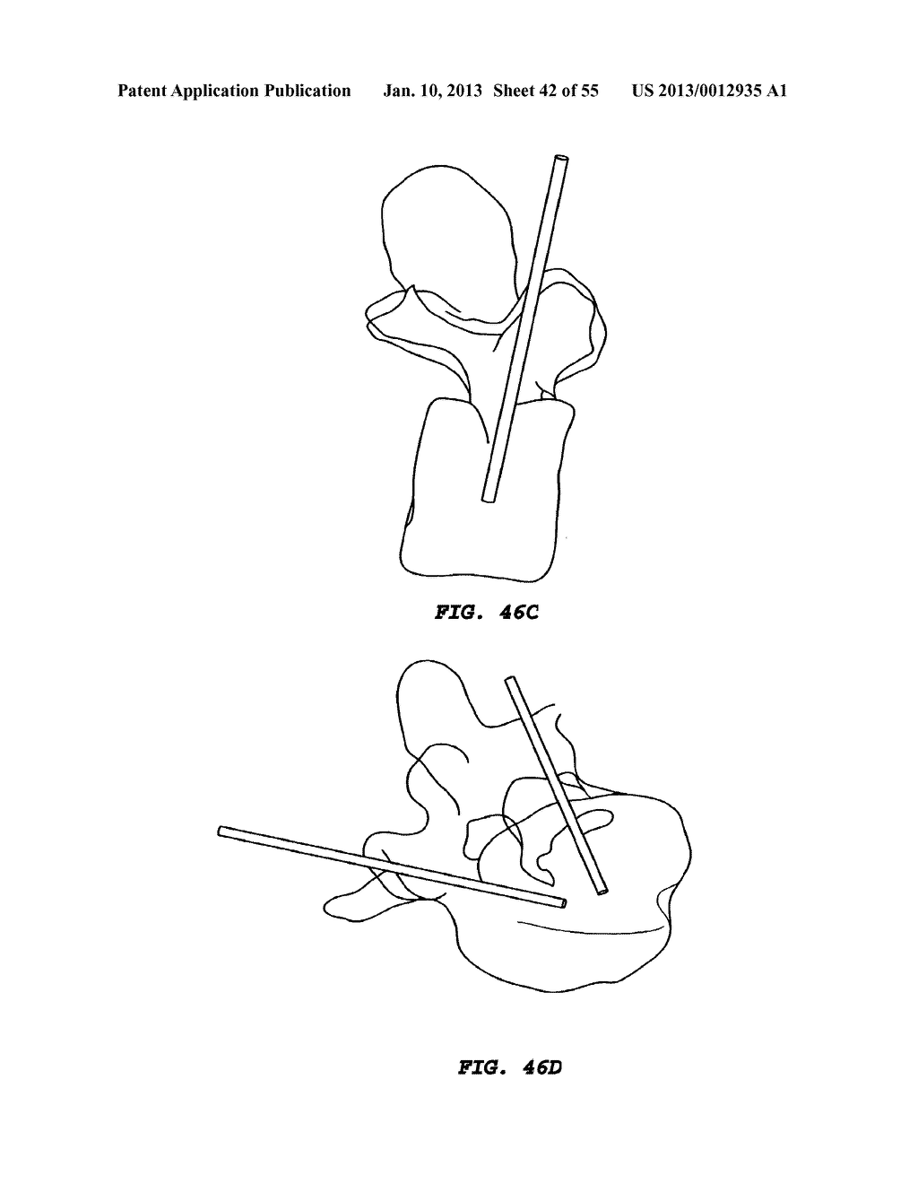 METHODS OF TREATING BACK PAIN - diagram, schematic, and image 43