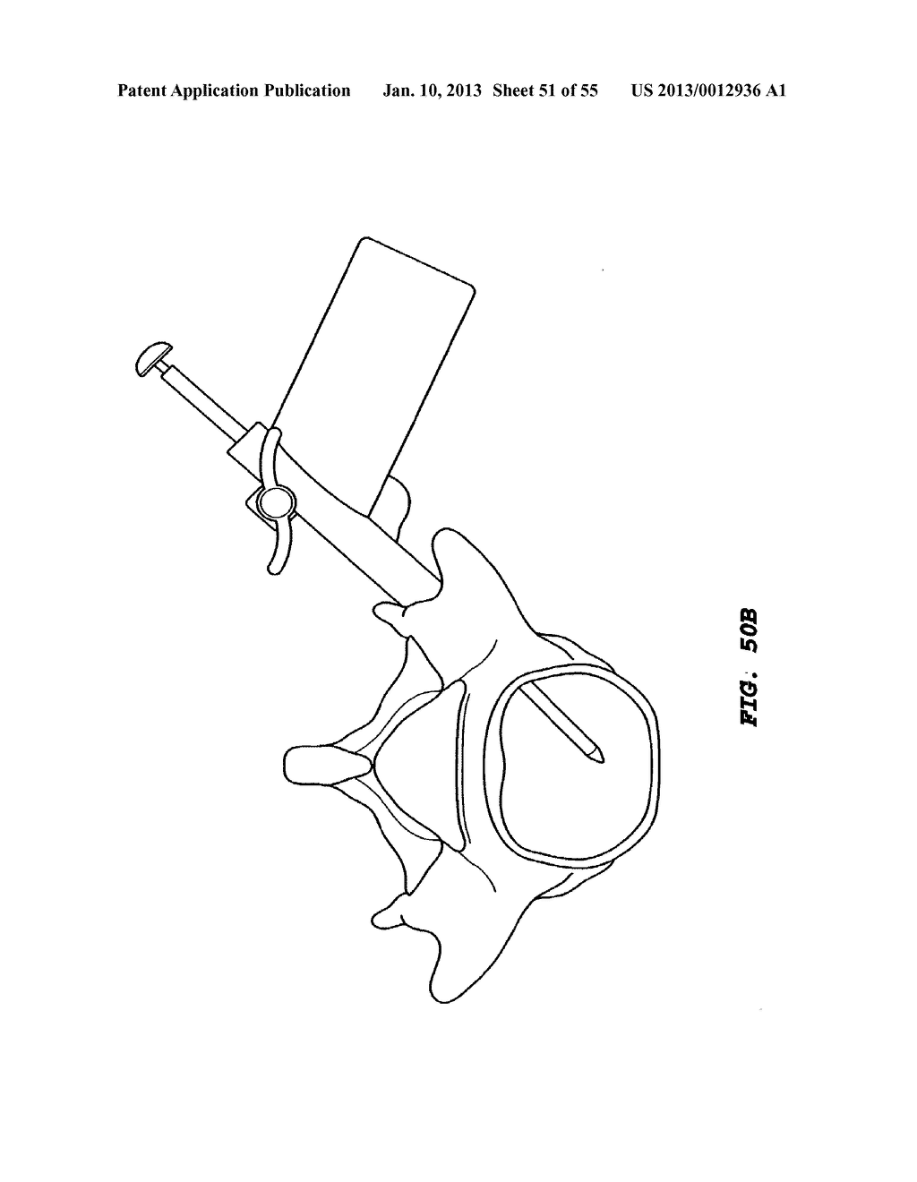 SYSTEM FOR HEATING  A VERTEBRAL BODY TO TREAT BACK PAIN - diagram, schematic, and image 52