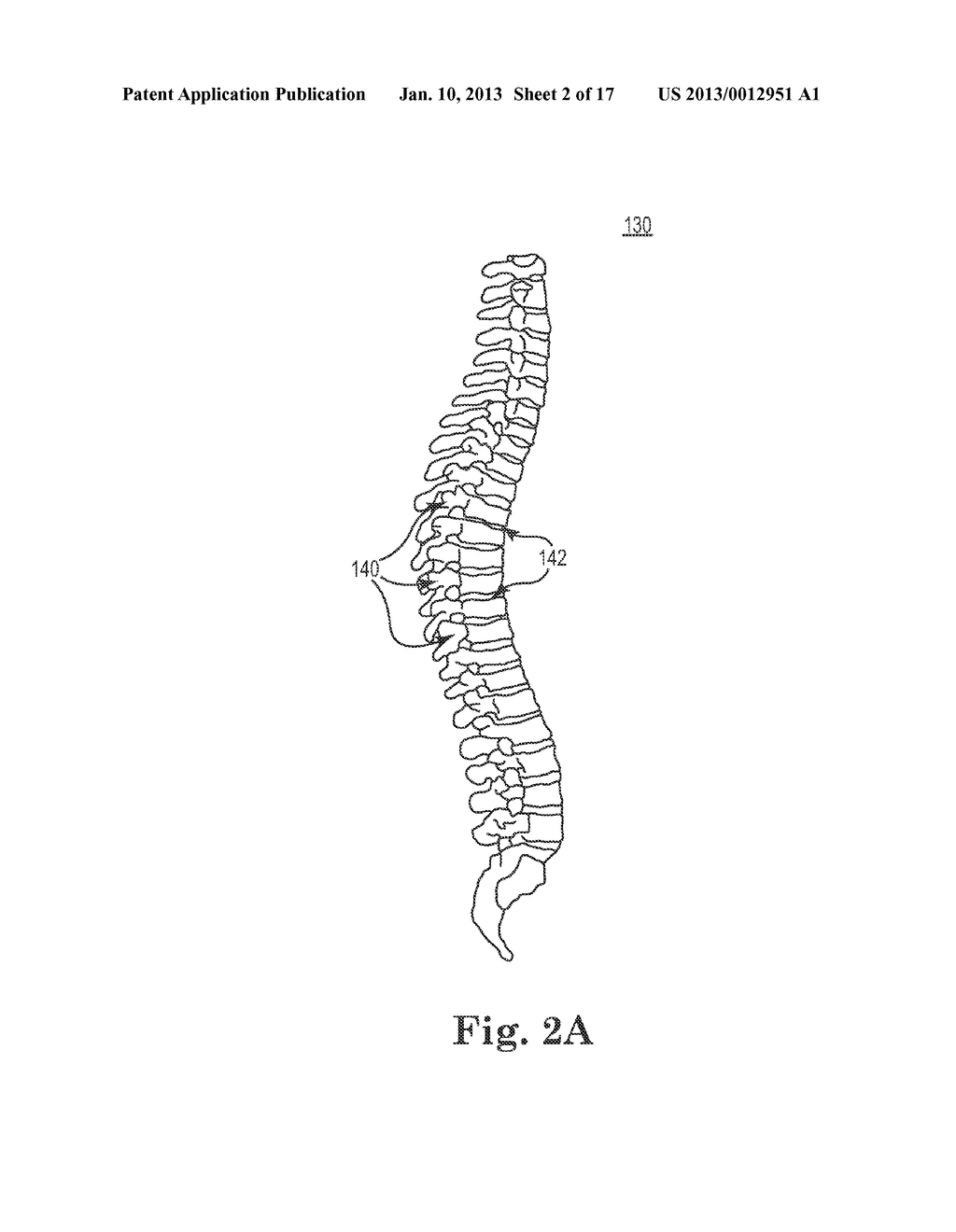 SYSTEMS AND METHODS FOR TREATING A SPINE THROUGH A SINGLE VERTEBRAL BODY     INSERTION POINT - diagram, schematic, and image 03