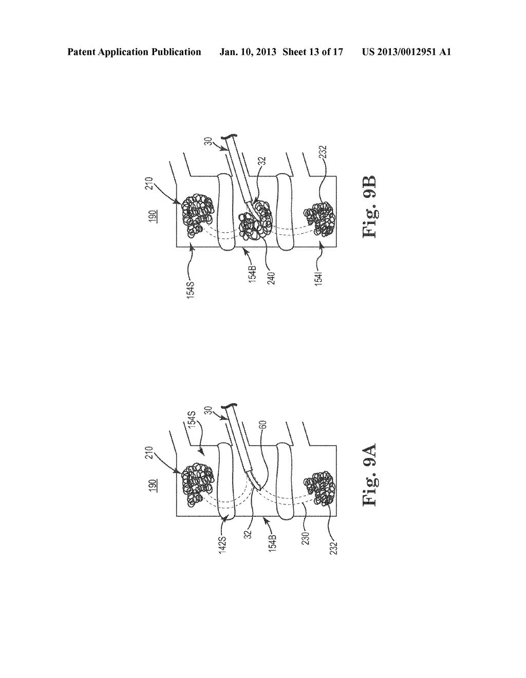 SYSTEMS AND METHODS FOR TREATING A SPINE THROUGH A SINGLE VERTEBRAL BODY     INSERTION POINT - diagram, schematic, and image 14