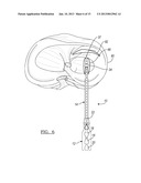 Method For Repairing A Meniscal Tear diagram and image