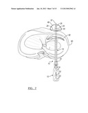 Method For Repairing A Meniscal Tear diagram and image