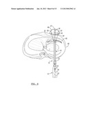 Method For Repairing A Meniscal Tear diagram and image