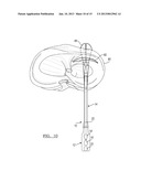 Method For Repairing A Meniscal Tear diagram and image