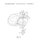 Method For Repairing A Meniscal Tear diagram and image