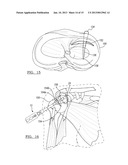 Method For Repairing A Meniscal Tear diagram and image