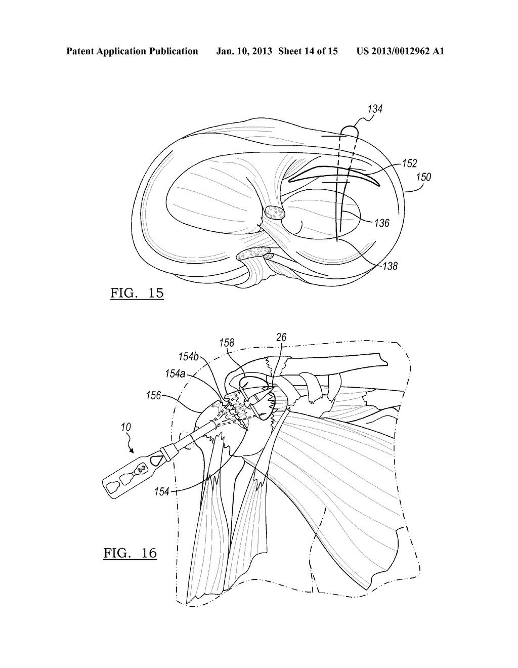 Method For Repairing A Meniscal Tear - diagram, schematic, and image 15