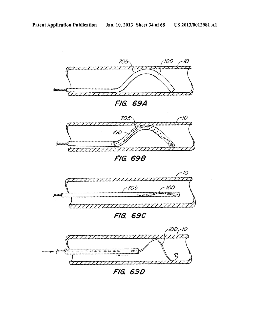 ENDOLUMINAL FILTER WITH FIXATION - diagram, schematic, and image 35