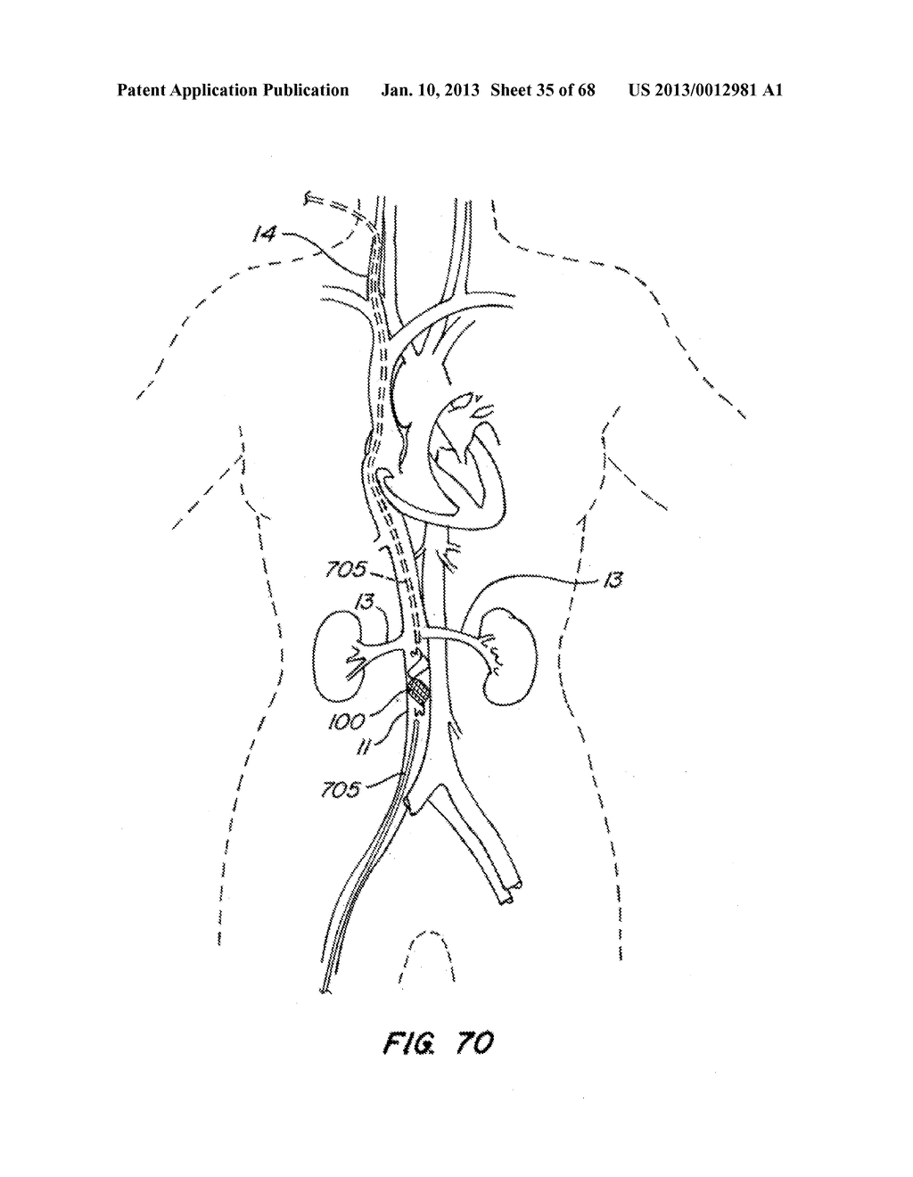 ENDOLUMINAL FILTER WITH FIXATION - diagram, schematic, and image 36