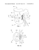 APPARATUS FOR COMPRESSING OR DECOMPRESSING A SPINAL DISC AND METHOD OF USE     THEREOF diagram and image