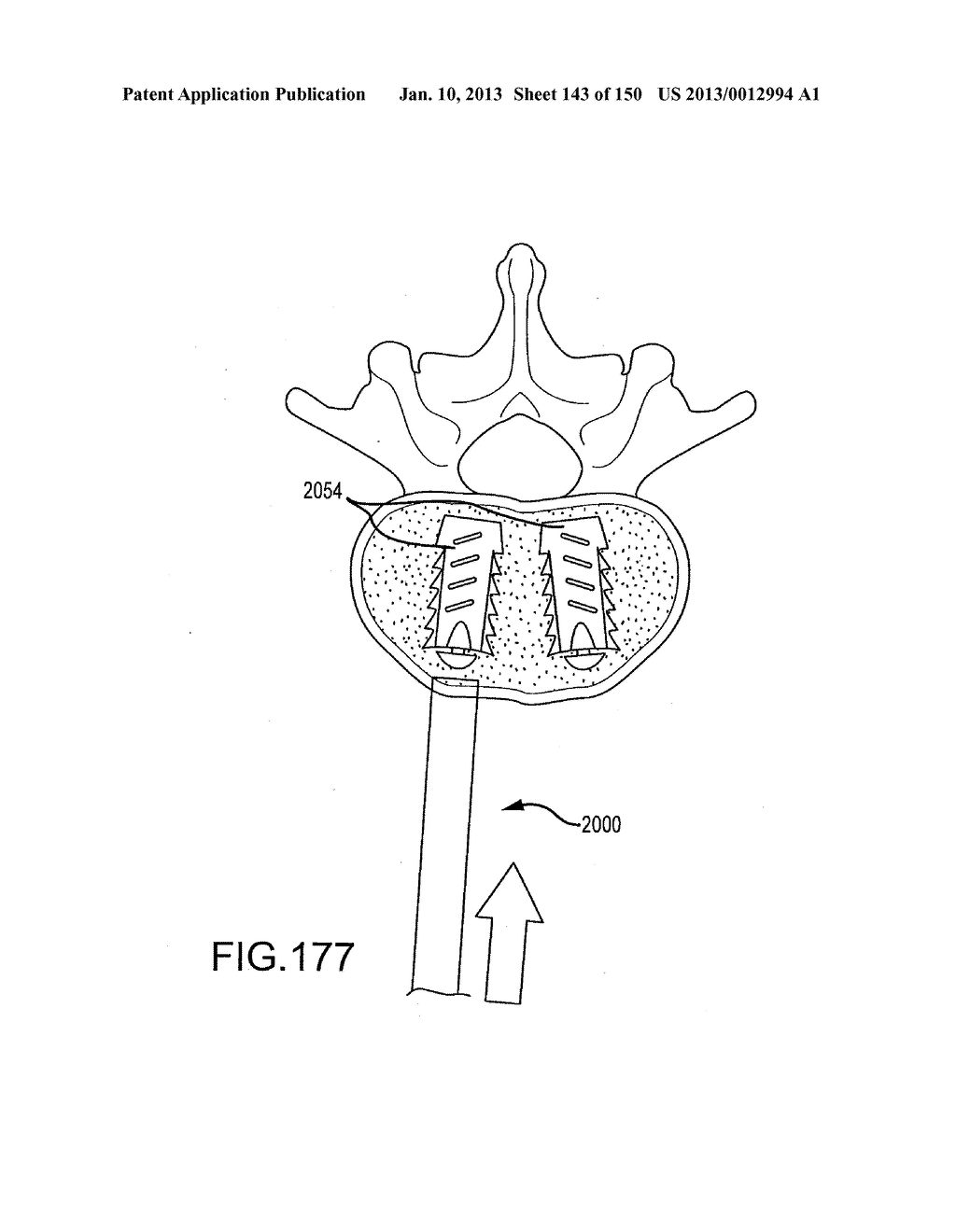 VERTEBRAL JOINT IMPLANTS AND DELIVERY TOOLS - diagram, schematic, and image 144