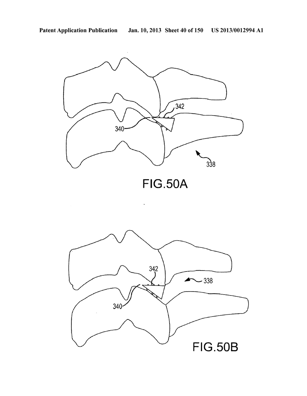 VERTEBRAL JOINT IMPLANTS AND DELIVERY TOOLS - diagram, schematic, and image 41