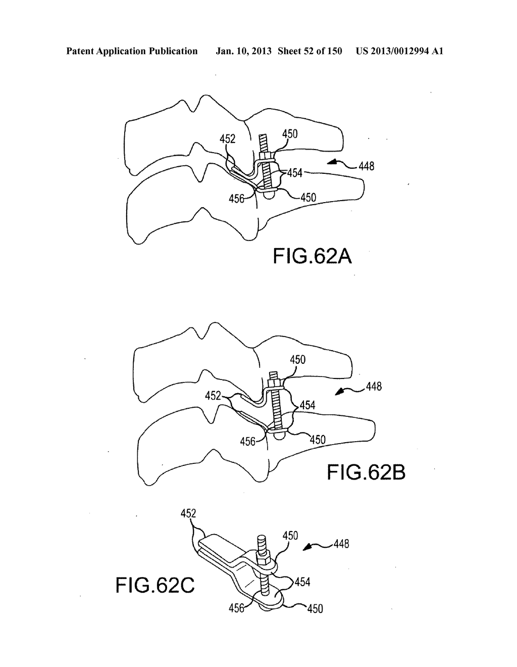 VERTEBRAL JOINT IMPLANTS AND DELIVERY TOOLS - diagram, schematic, and image 53