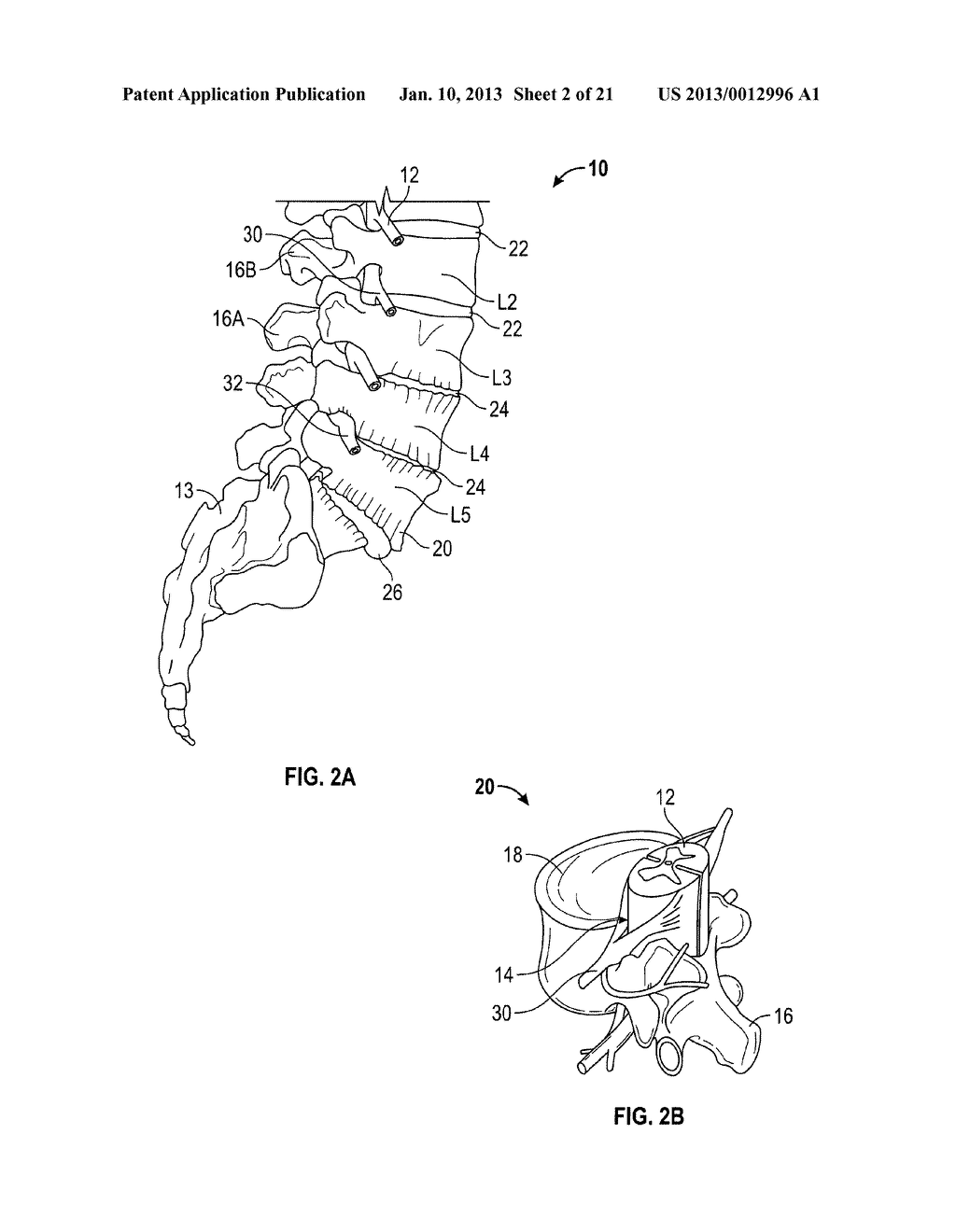 SPINOUS PROCESS DEVICE - diagram, schematic, and image 03