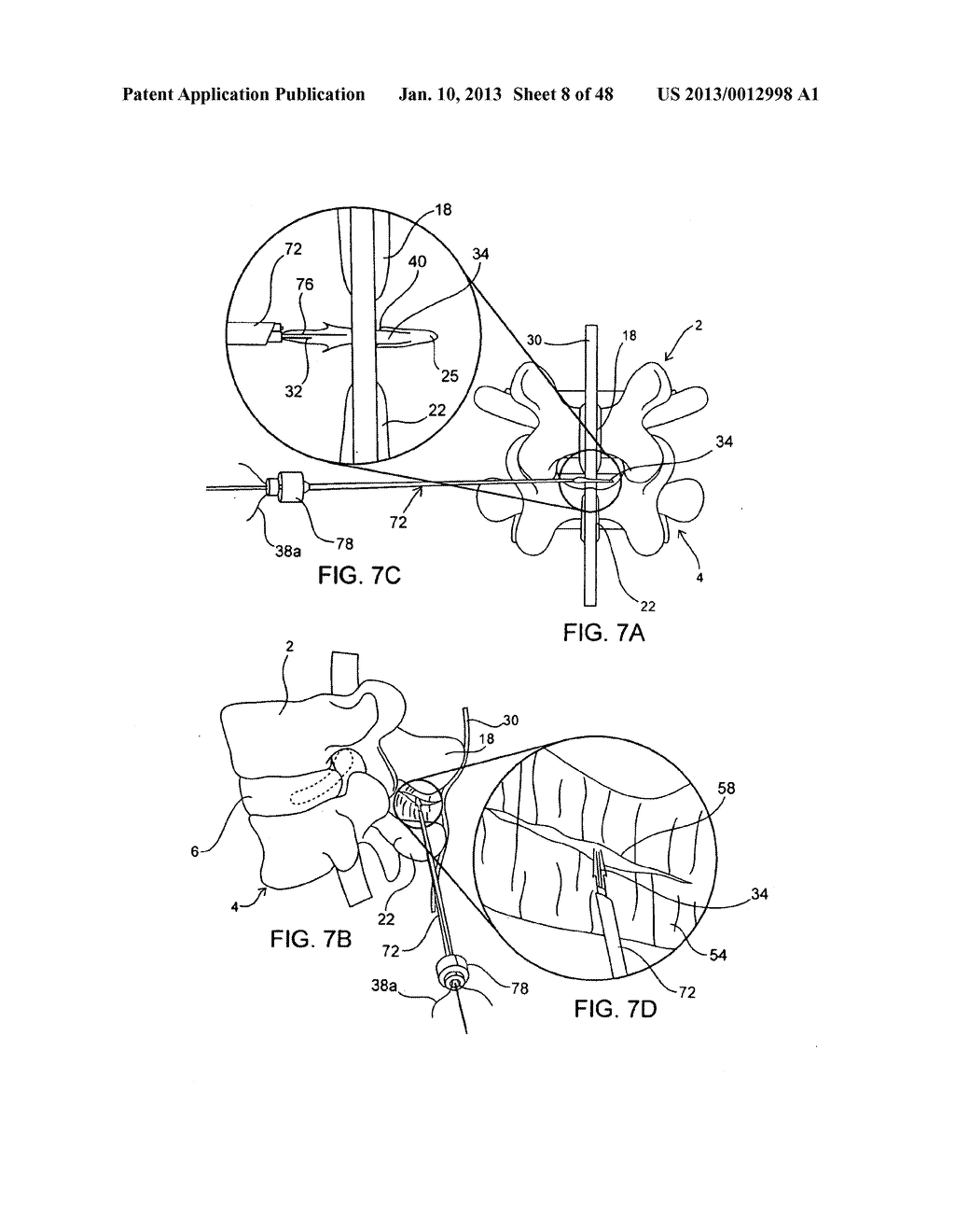 SYSTEMS AND METHODS FOR POSTERIOR DYNAMIC STABILIZATION OF THE SPINE - diagram, schematic, and image 09