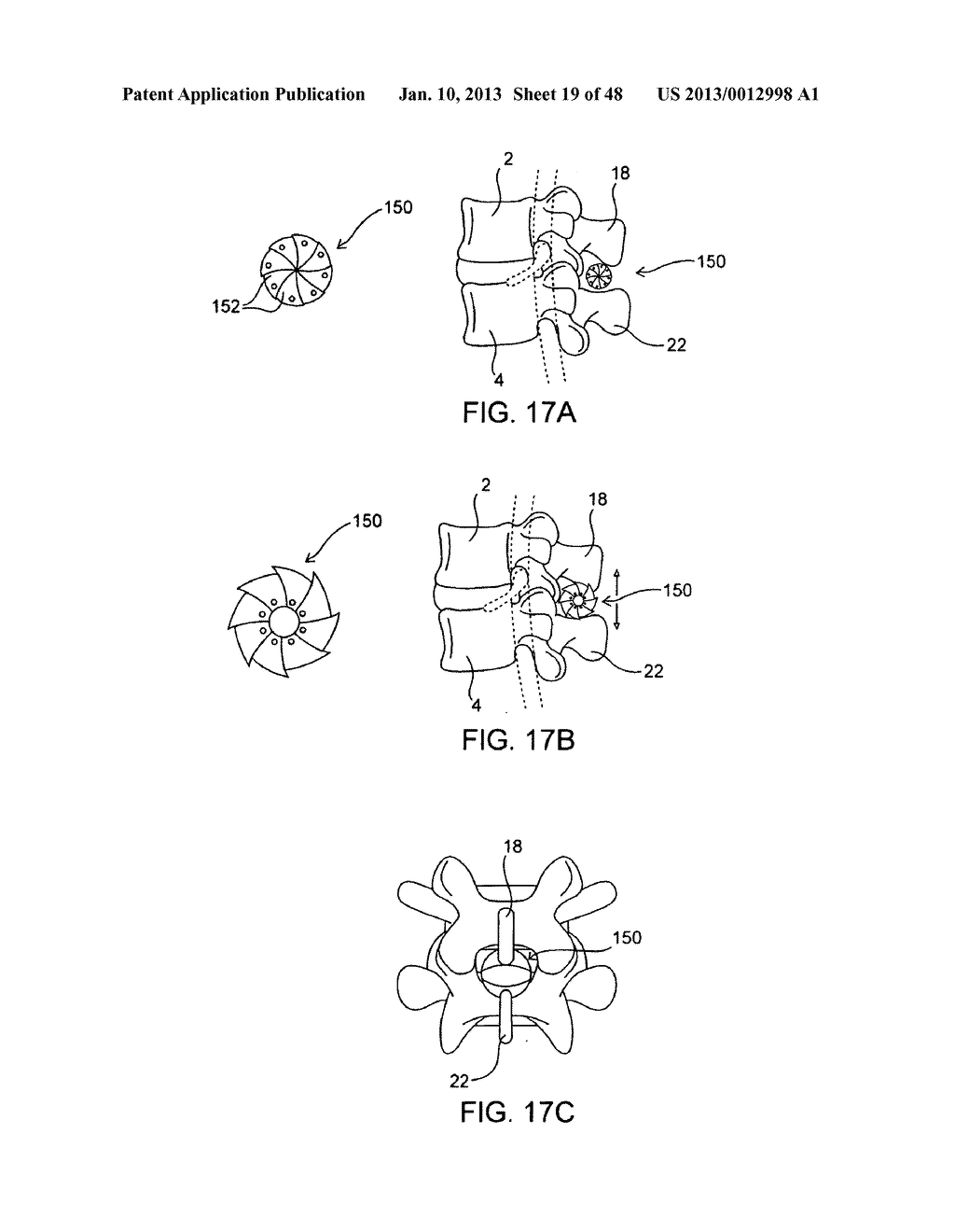 SYSTEMS AND METHODS FOR POSTERIOR DYNAMIC STABILIZATION OF THE SPINE - diagram, schematic, and image 20