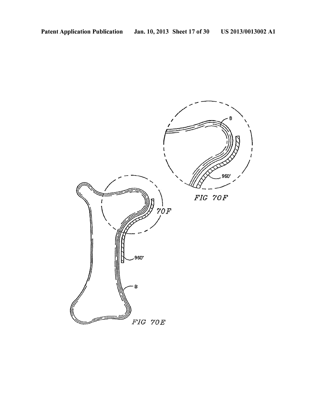 ORTHOPEDIC IMPLANT WITH LOCKING ELEMENT - diagram, schematic, and image 18