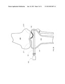 COMBINATION DIRECTIONAL AND NON-DIRECTIONAL BONE TAMP diagram and image