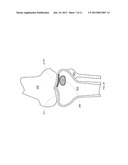 COMBINATION DIRECTIONAL AND NON-DIRECTIONAL BONE TAMP diagram and image